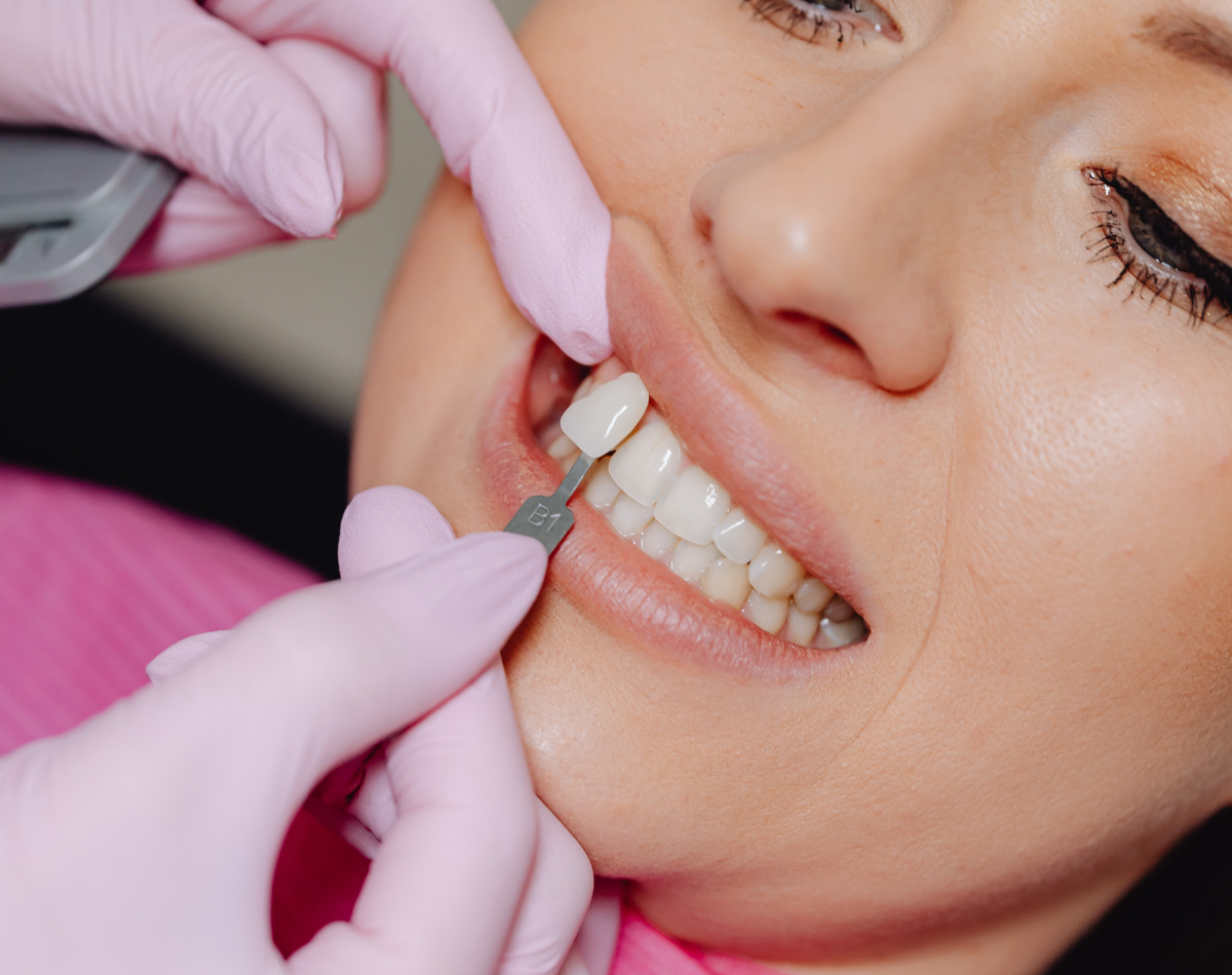 Dental veneers
