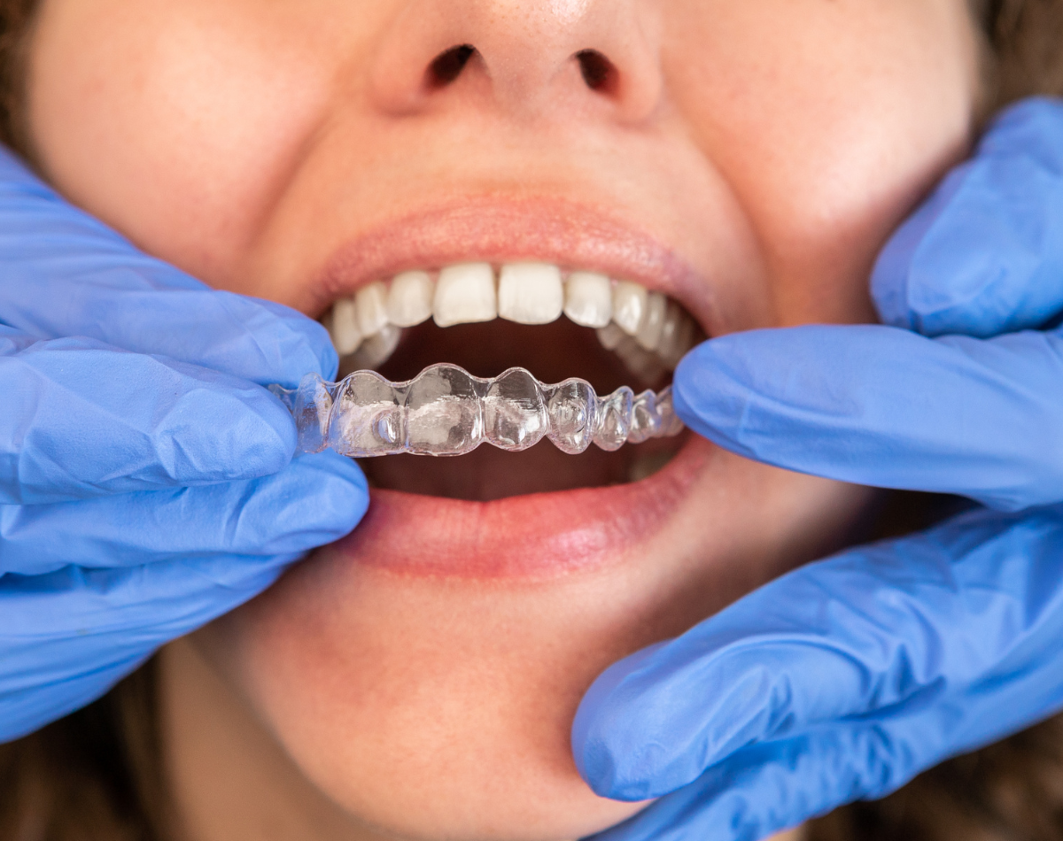 Patient fitting a clear Invisalign aligner