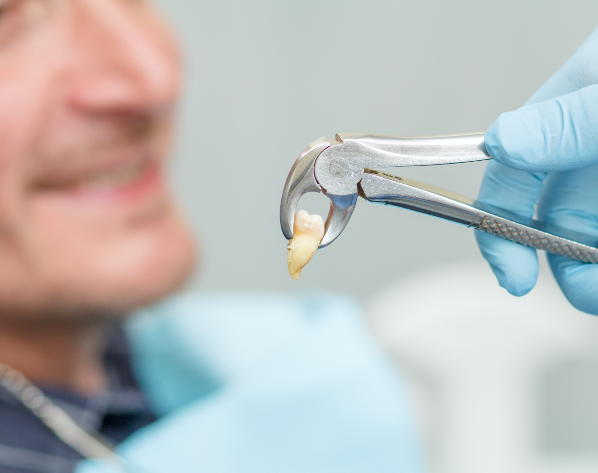 Tooth extractions